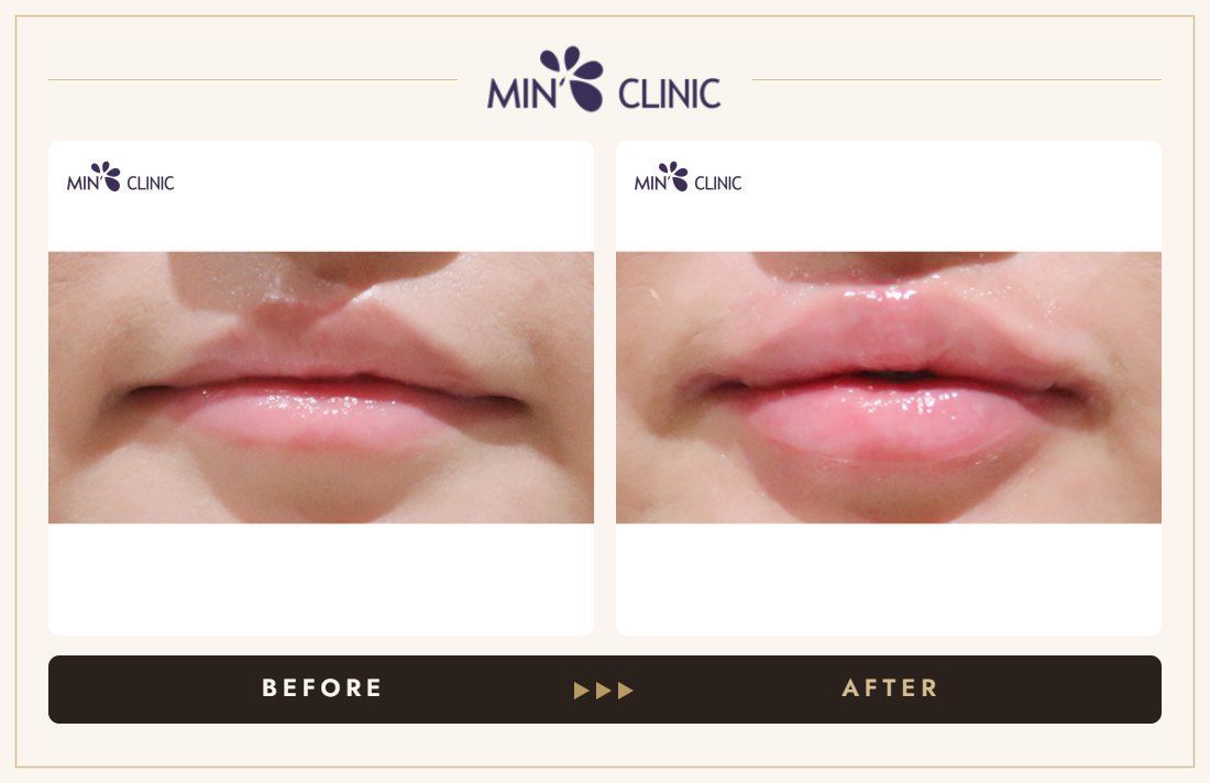 Lip filler before and after, case 27 – MIN Clinic Seoul