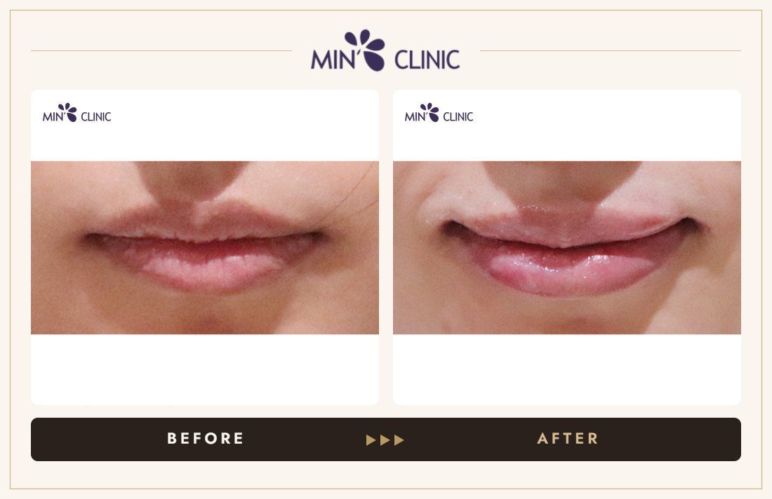 Lip filler before and after, case 28 – MIN Clinic Seoul