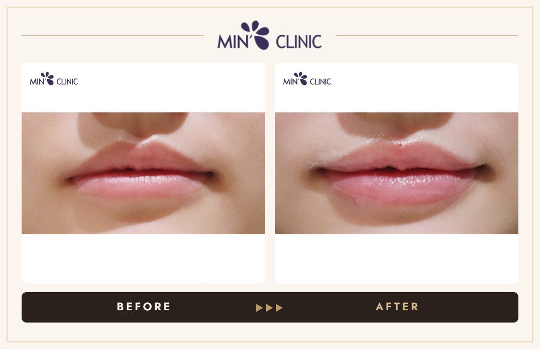 Lip filler before and after – MIN Clinic Gangnam, Seoul