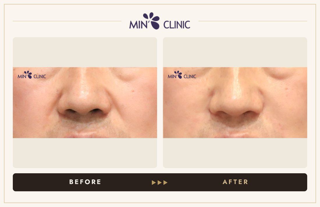 Marionette line filler before and after, case 1 – MIN Clinic Seoul