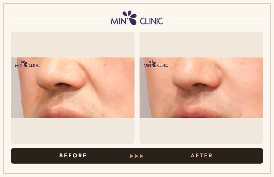 Marionette line filler before and after, case 2 – MIN Clinic Seoul