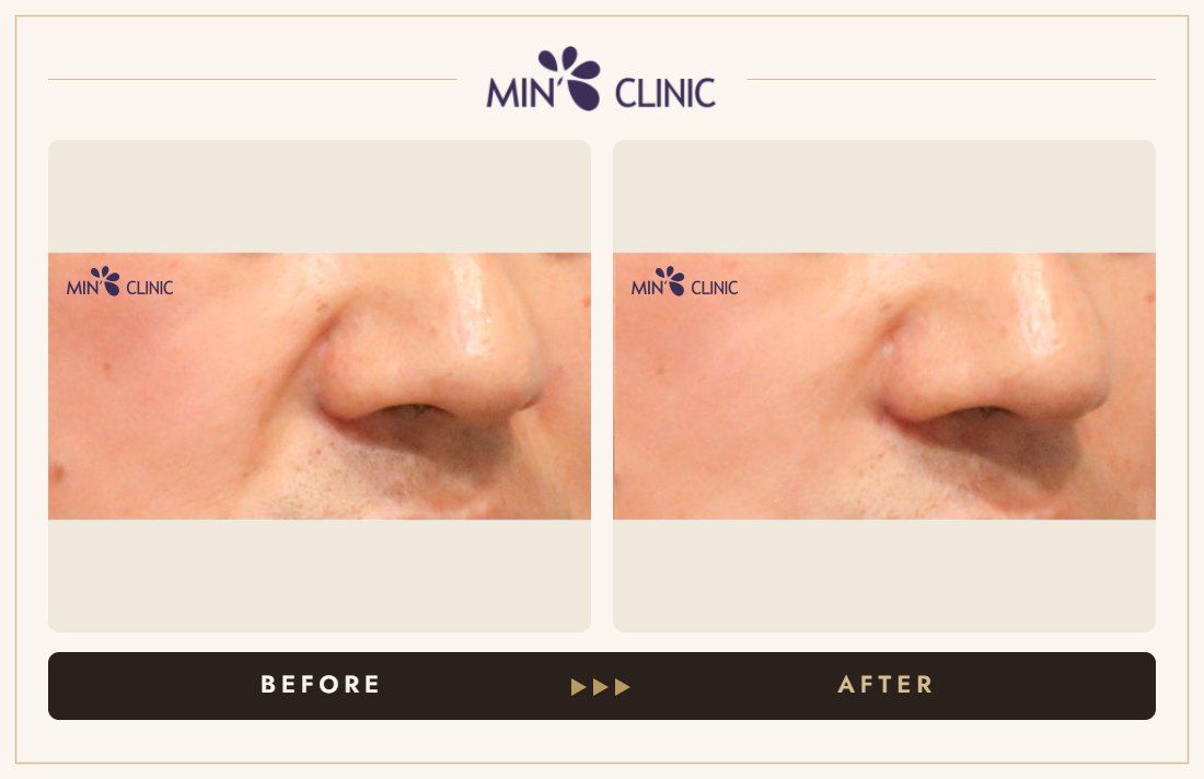 Marionette line filler before and after, case 3 – MIN Clinic Seoul