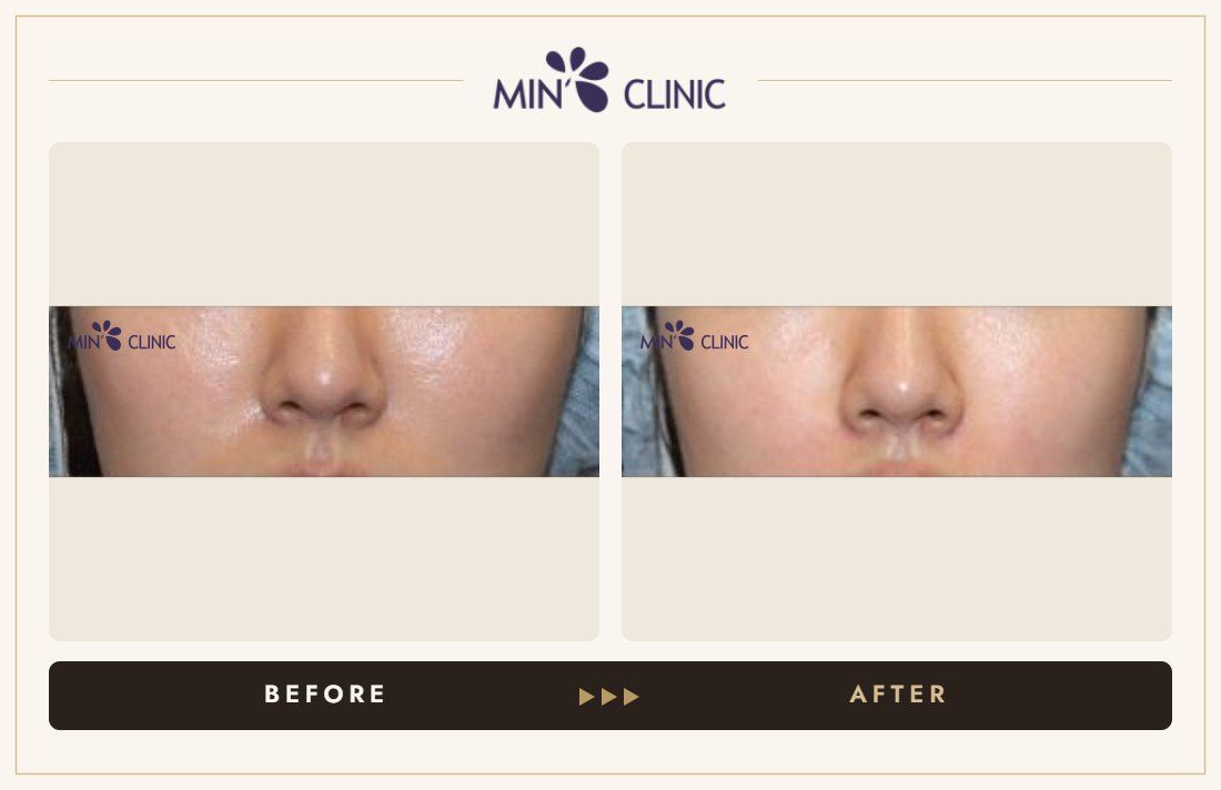 Marionette line filler before and after, case 4 – MIN Clinic Seoul