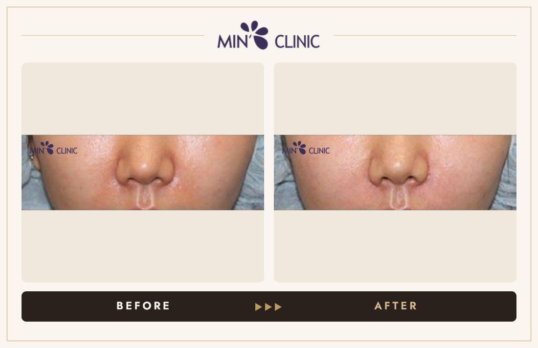 Marionette line filler before and after, case 5 – MIN Clinic Seoul