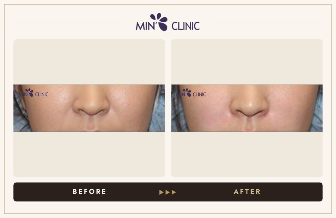 Marionette line filler before and after, case 6 – MIN Clinic Seoul