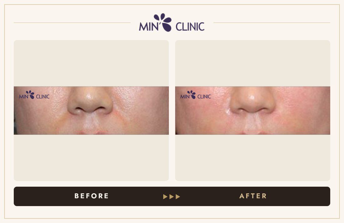 Marionette line filler before and after, case 7 – MIN Clinic Seoul