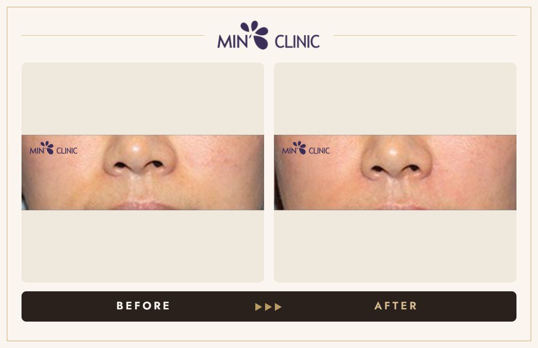 Marionette line filler before and after, case 8 – MIN Clinic Seoul