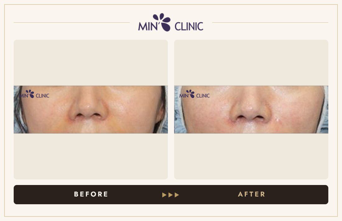 Marionette line filler before and after, case 9 – MIN Clinic Seoul