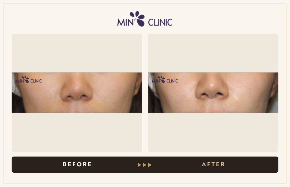 Marionette line filler before and after, case 10 – MIN Clinic Seoul