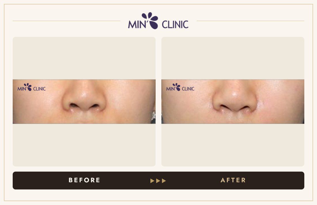 Marionette line filler before and after, case 11 – MIN Clinic Seoul