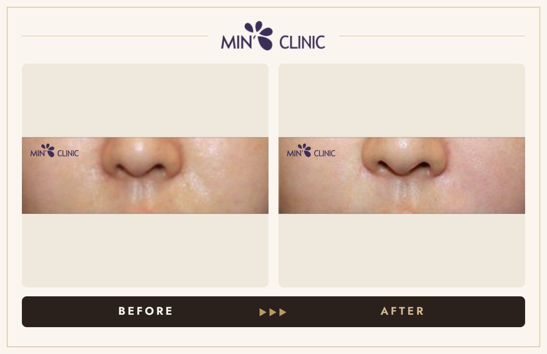 Marionette line filler before and after, case 12 – MIN Clinic Seoul