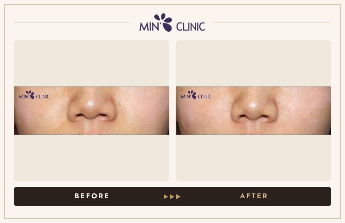 Marionette line filler before and after, case 13 – MIN Clinic Seoul