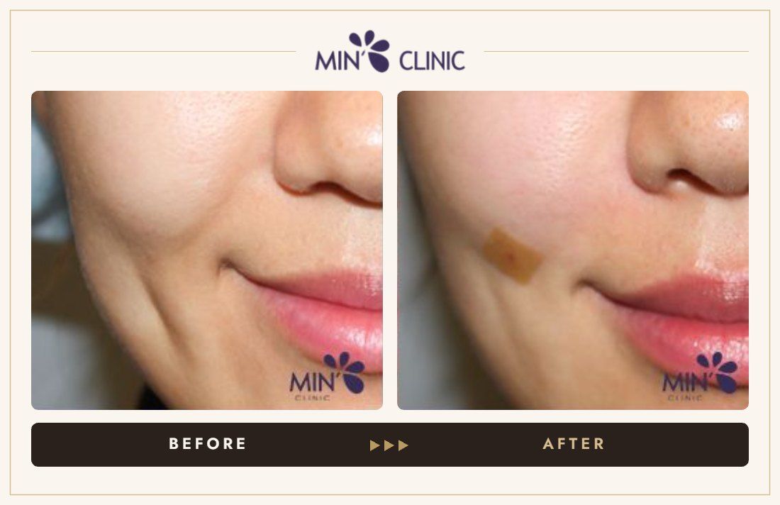 Marionette line filler before and after, case 14 – MIN Clinic Seoul