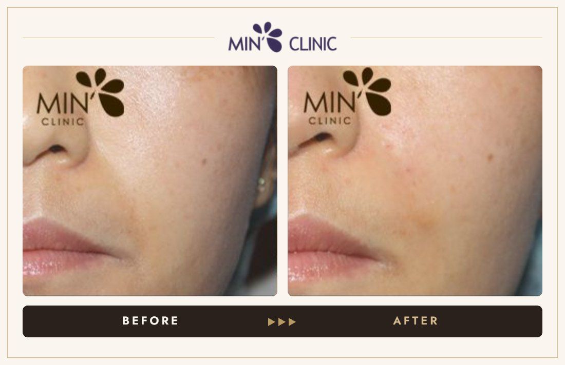 Marionette line filler before and after, case 15 – MIN Clinic Seoul