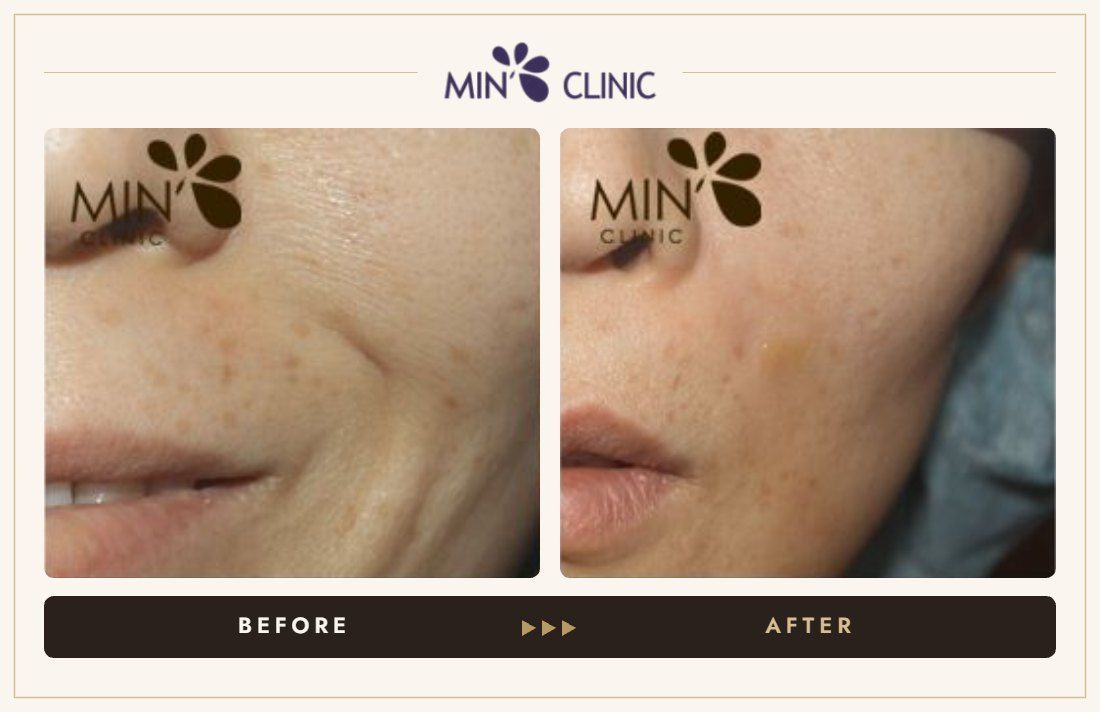 Marionette line filler before and after, case 16 – MIN Clinic Seoul