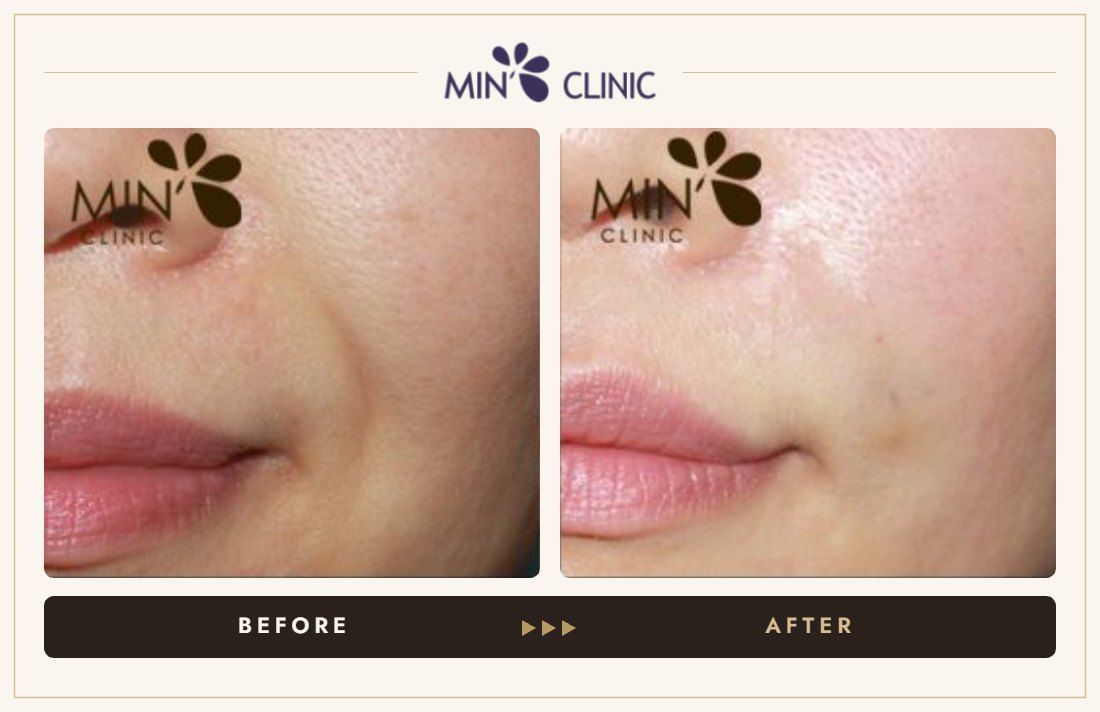 Marionette line filler before and after, case 17 – MIN Clinic Seoul
