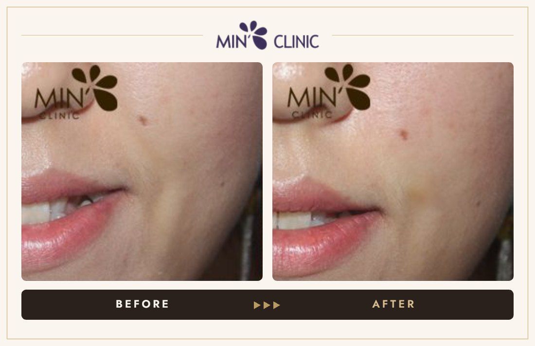 Marionette line filler before and after, case 18 – MIN Clinic Seoul