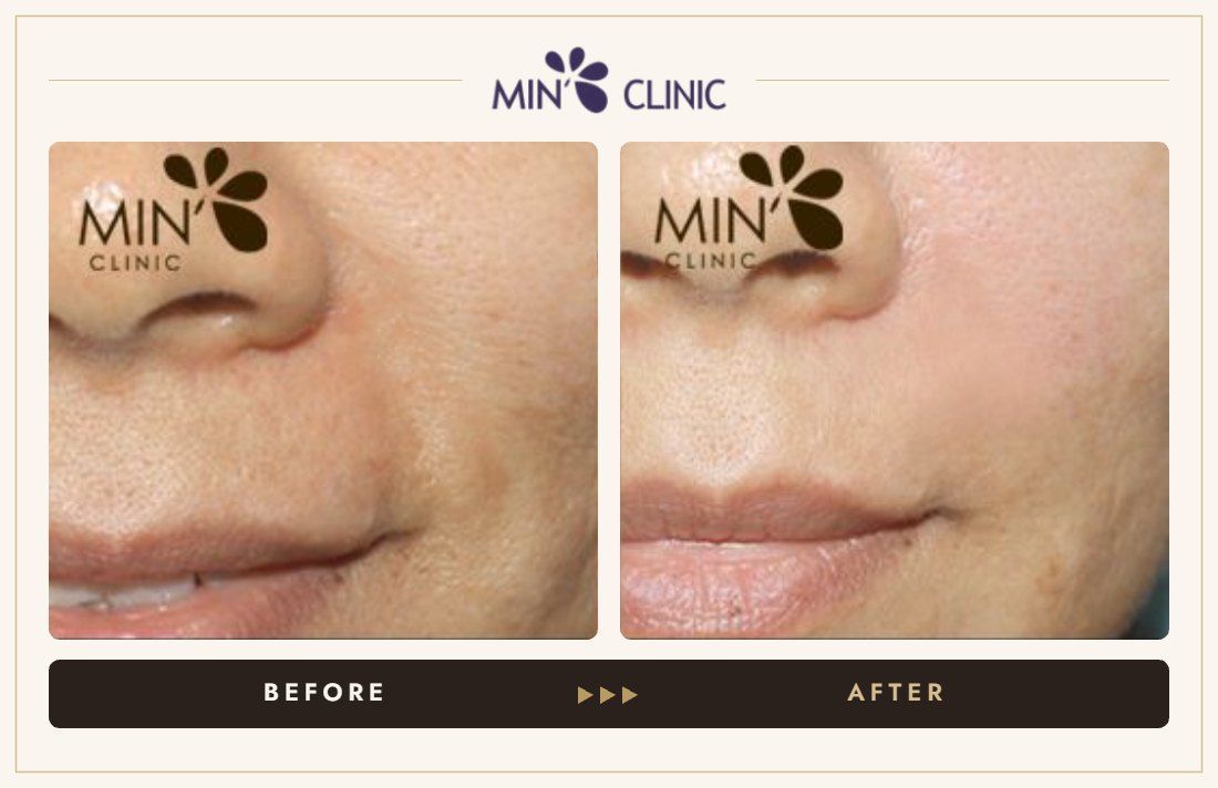 Marionette line filler before and after, case 19 – MIN Clinic Seoul