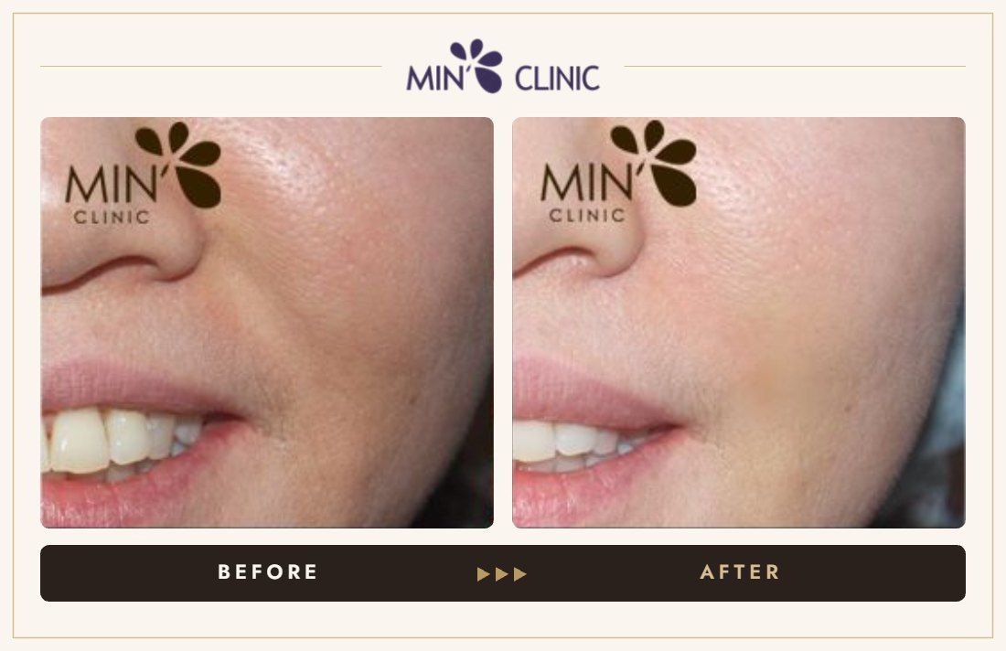 Marionette line filler before and after, case 20 – MIN Clinic Seoul