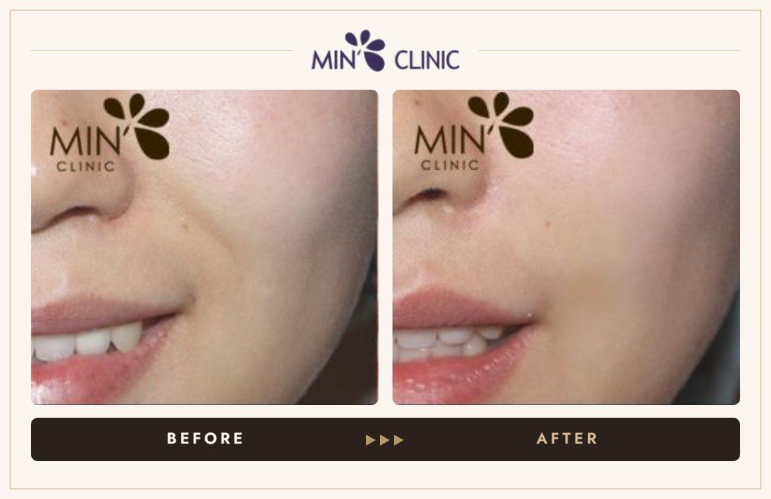 Marionette line filler before and after, case 21 – MIN Clinic Seoul