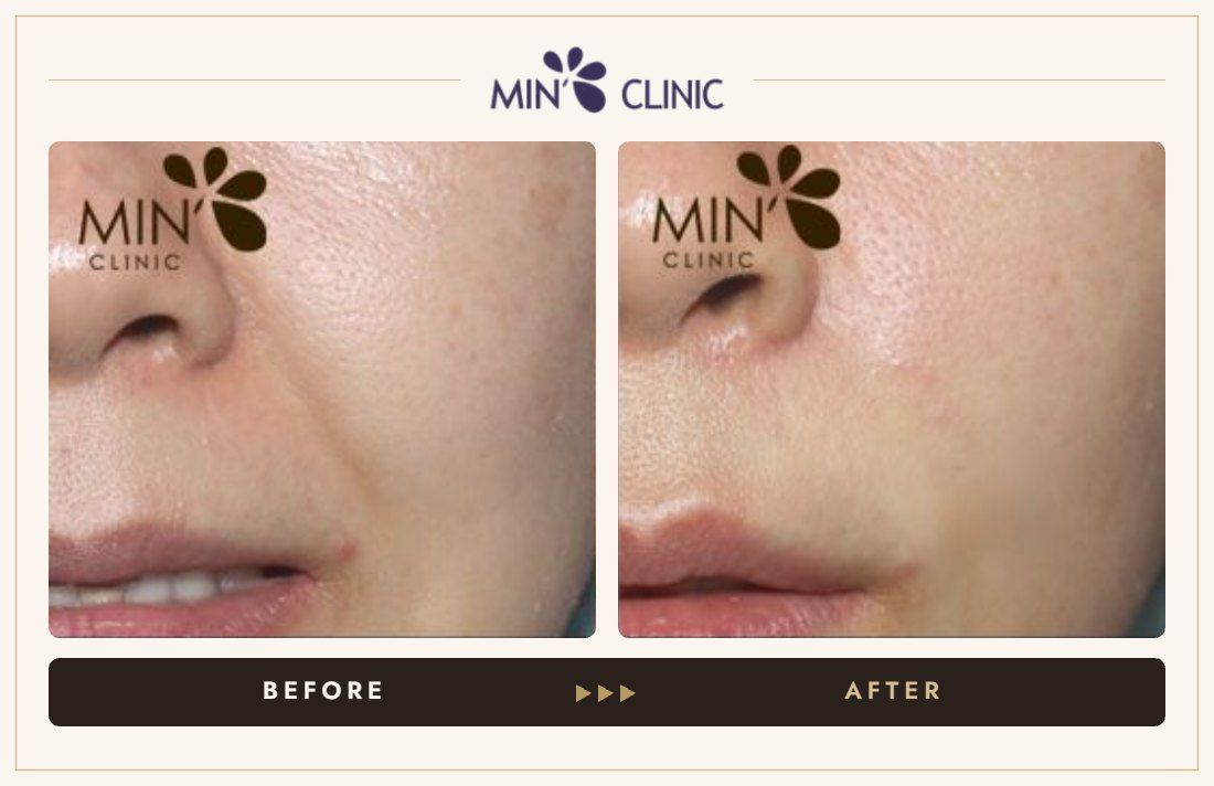 Marionette line filler before and after, case 22 – MIN Clinic Seoul