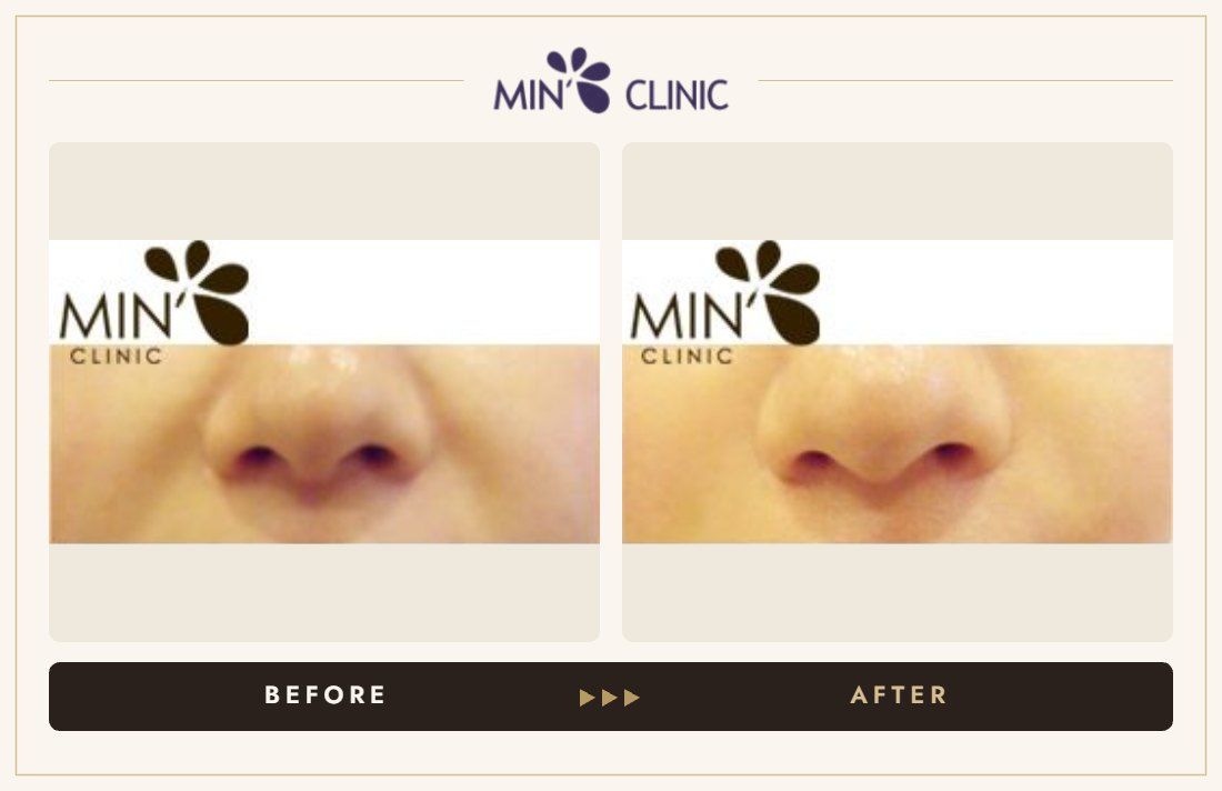 Marionette line filler before and after, case 23 – MIN Clinic Seoul