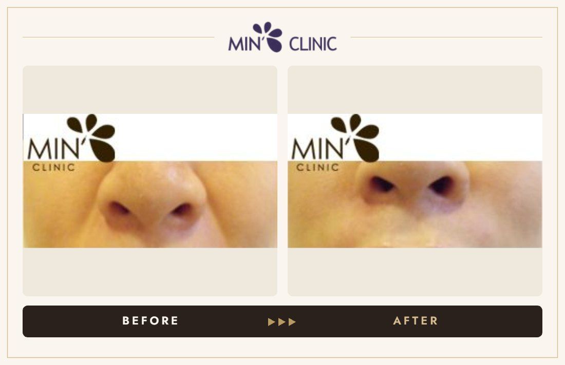 Marionette line filler before and after, case 24 – MIN Clinic Seoul