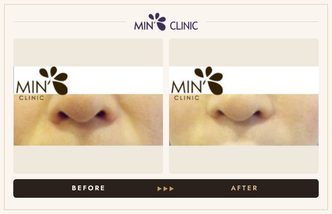Marionette line filler before and after – MIN Clinic Gangnam, Seoul
