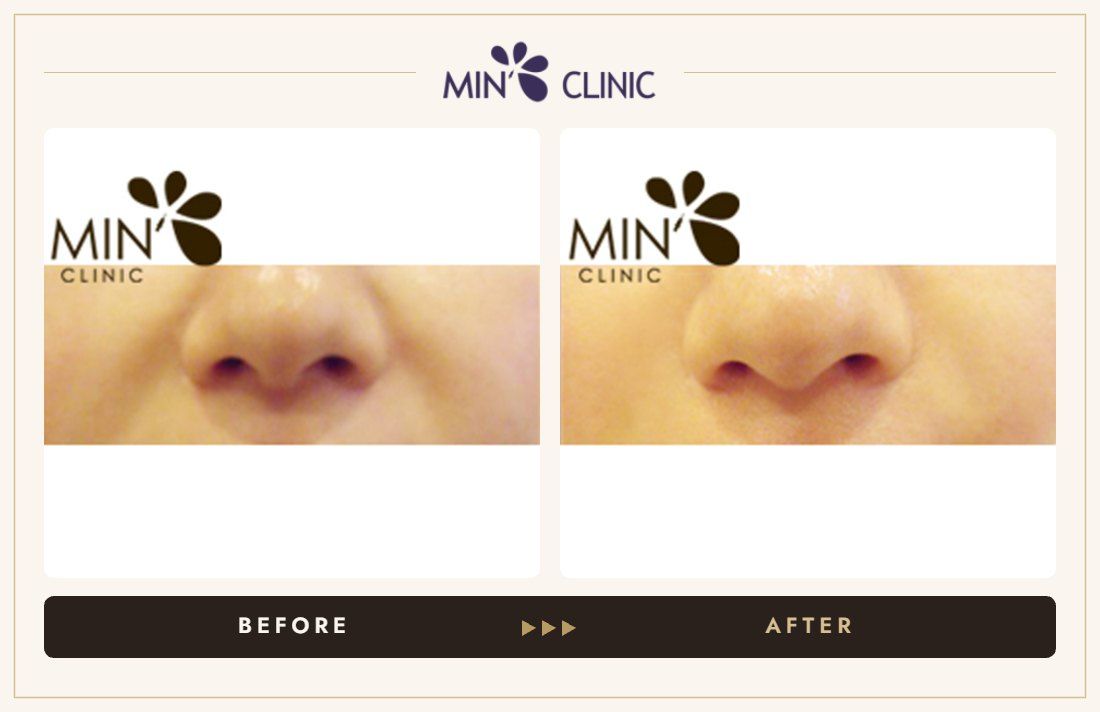 Nasolabial filler before and after, case 1 – MIN Clinic Seoul