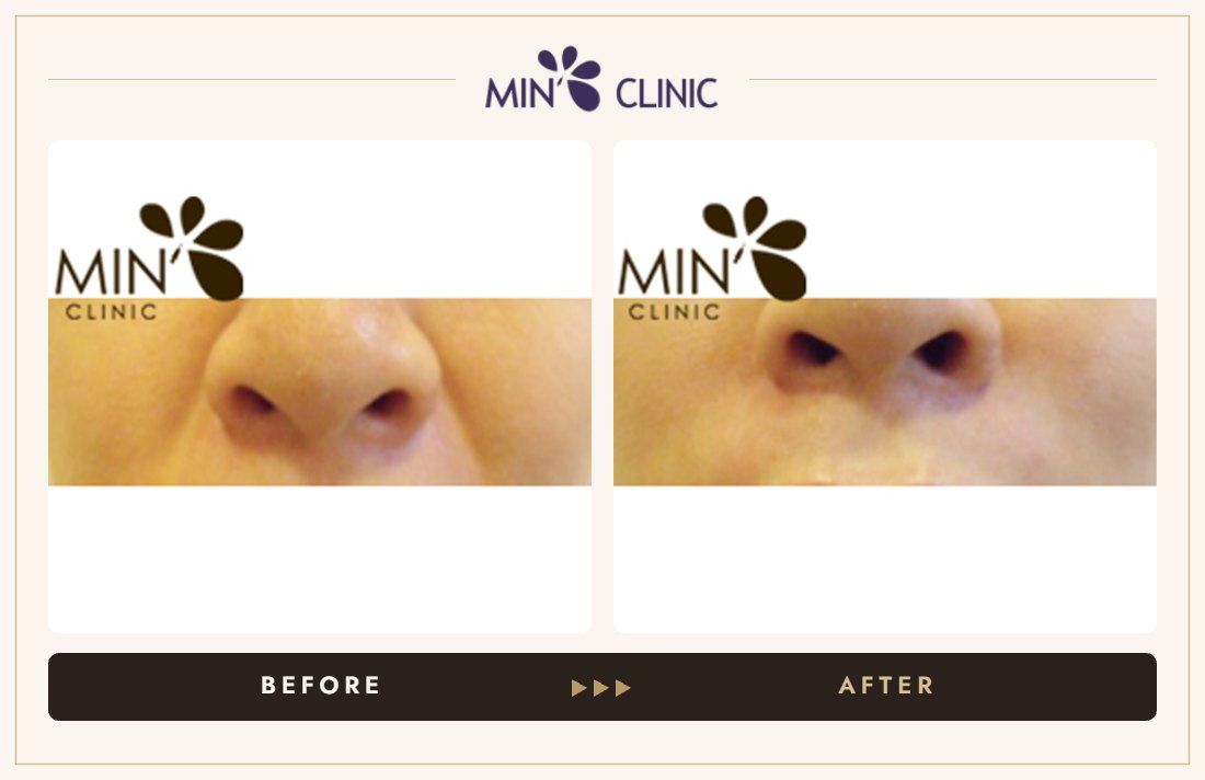 Nasolabial filler before and after, case 2 – MIN Clinic Seoul