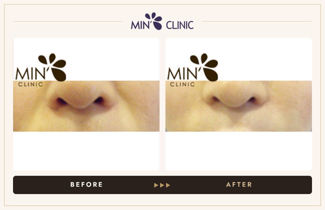 Nasolabial filler before and after, case 3 – MIN Clinic Seoul