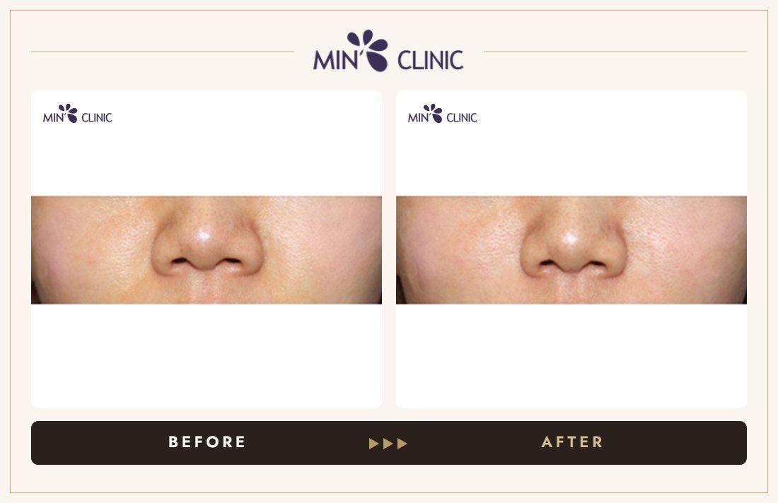 Nasolabial filler before and after, case 4 – MIN Clinic Seoul