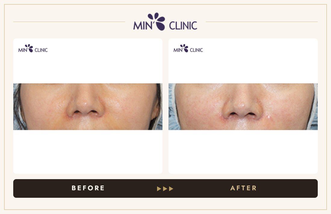 Nasolabial filler before and after, case 5 – MIN Clinic Seoul