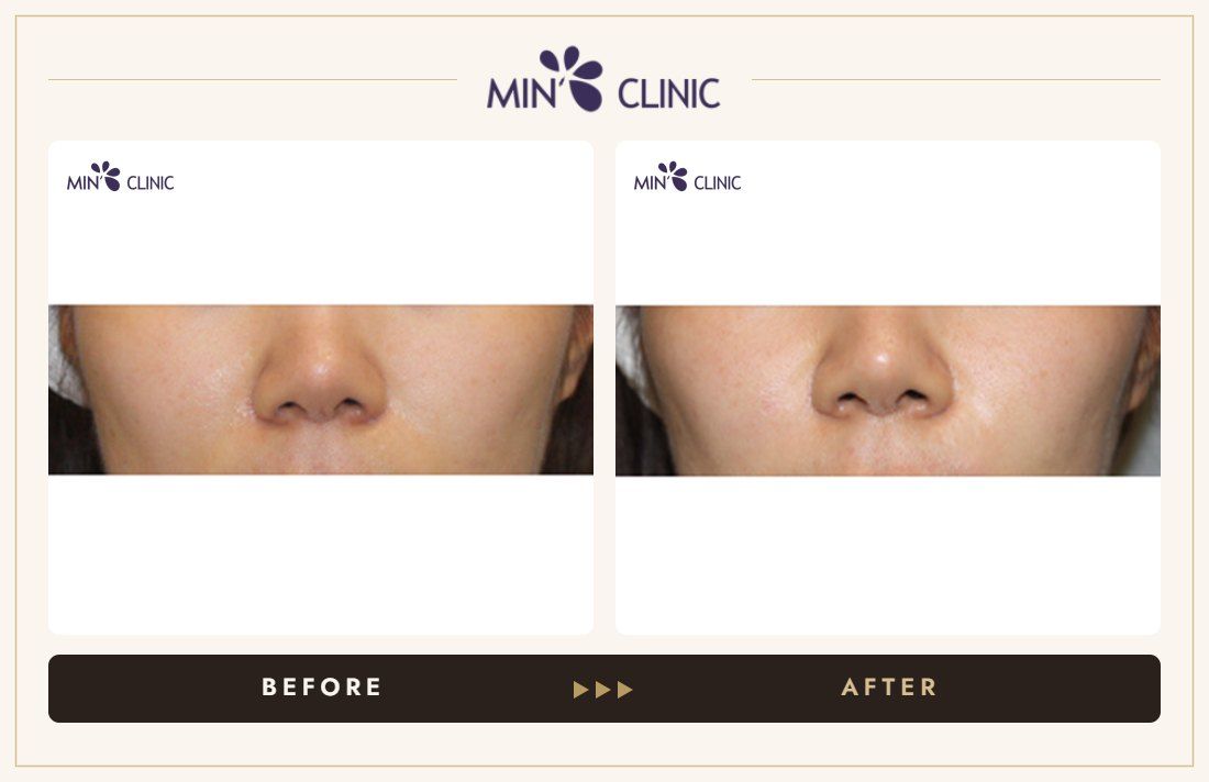 Nasolabial filler before and after, case 6 – MIN Clinic Seoul