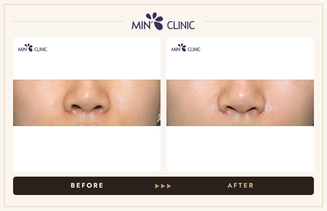 Nasolabial filler before and after, case 7 – MIN Clinic Seoul