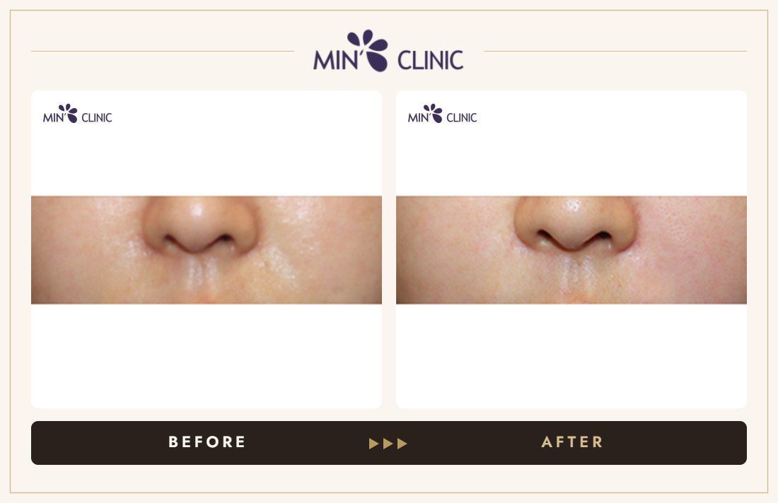 Nasolabial filler before and after, case 8 – MIN Clinic Seoul