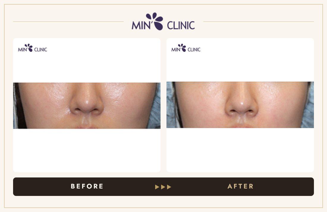 Nasolabial filler before and after, case 9 – MIN Clinic Seoul