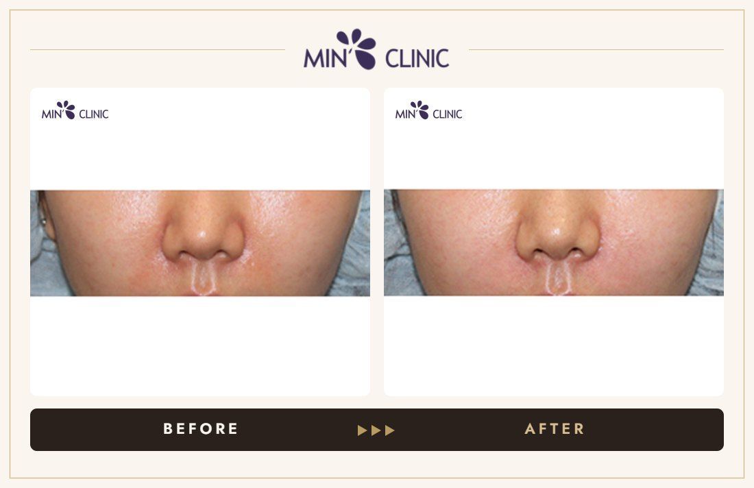 Nasolabial filler before and after, case 10 – MIN Clinic Seoul