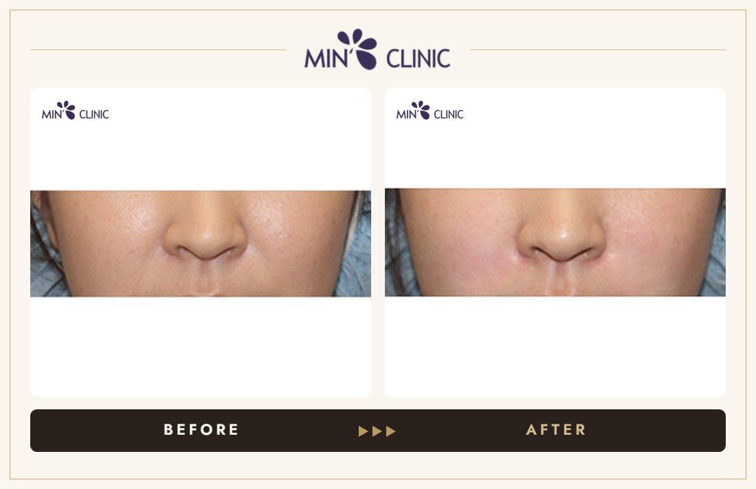 Nasolabial filler before and after, case 11 – MIN Clinic Seoul