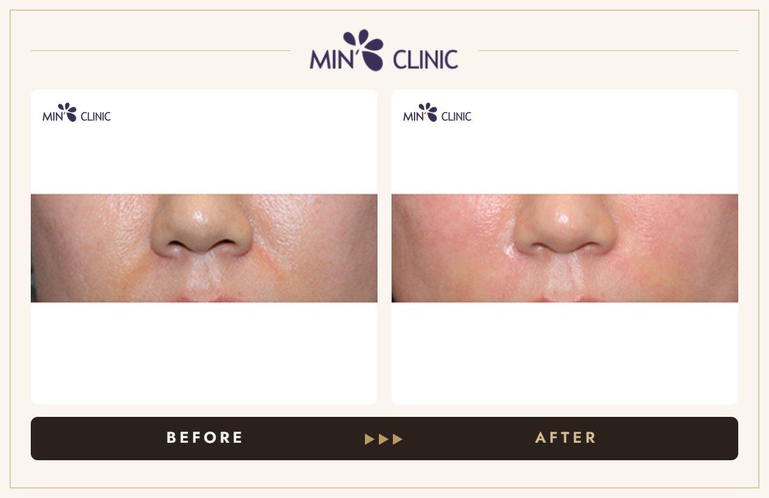 Nasolabial filler before and after, case 12 – MIN Clinic Seoul