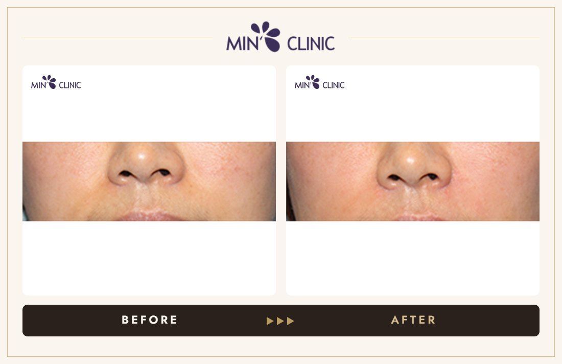 Nasolabial filler before and after, case 13 – MIN Clinic Seoul