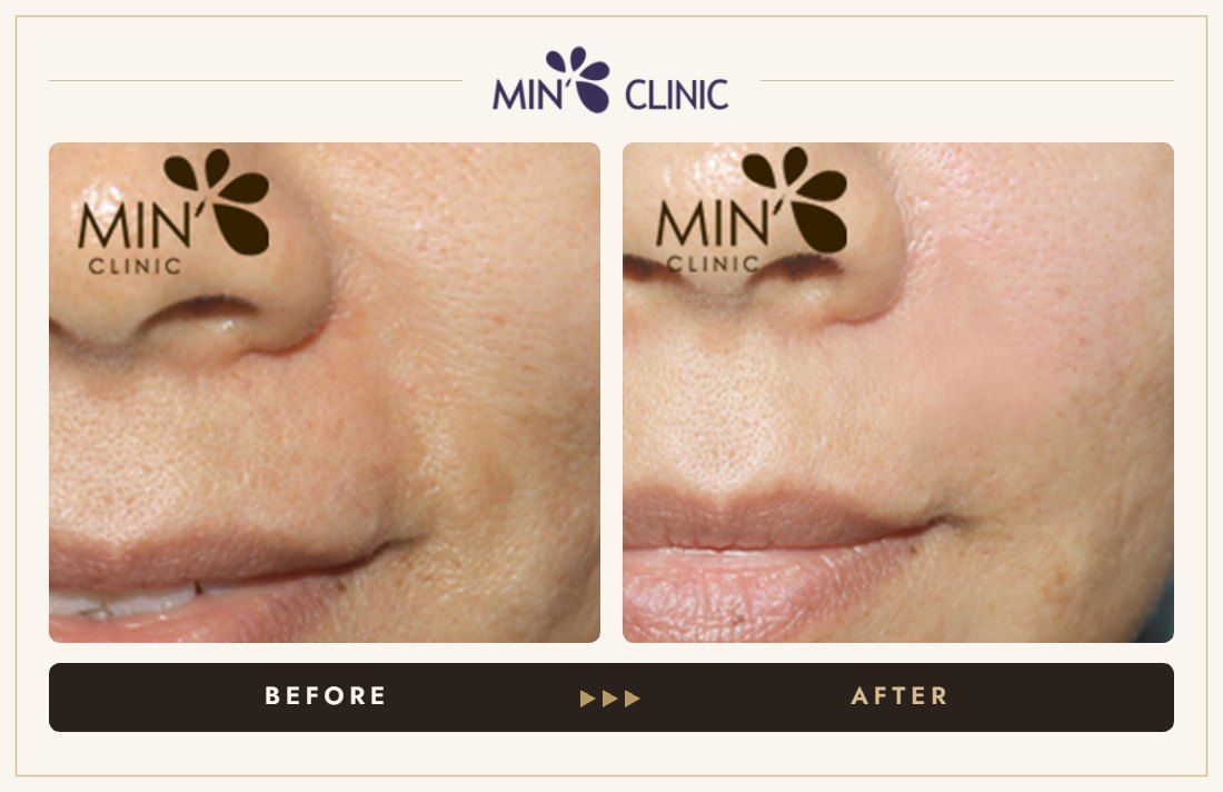 Nasolabial filler before and after, case 14 – MIN Clinic Seoul