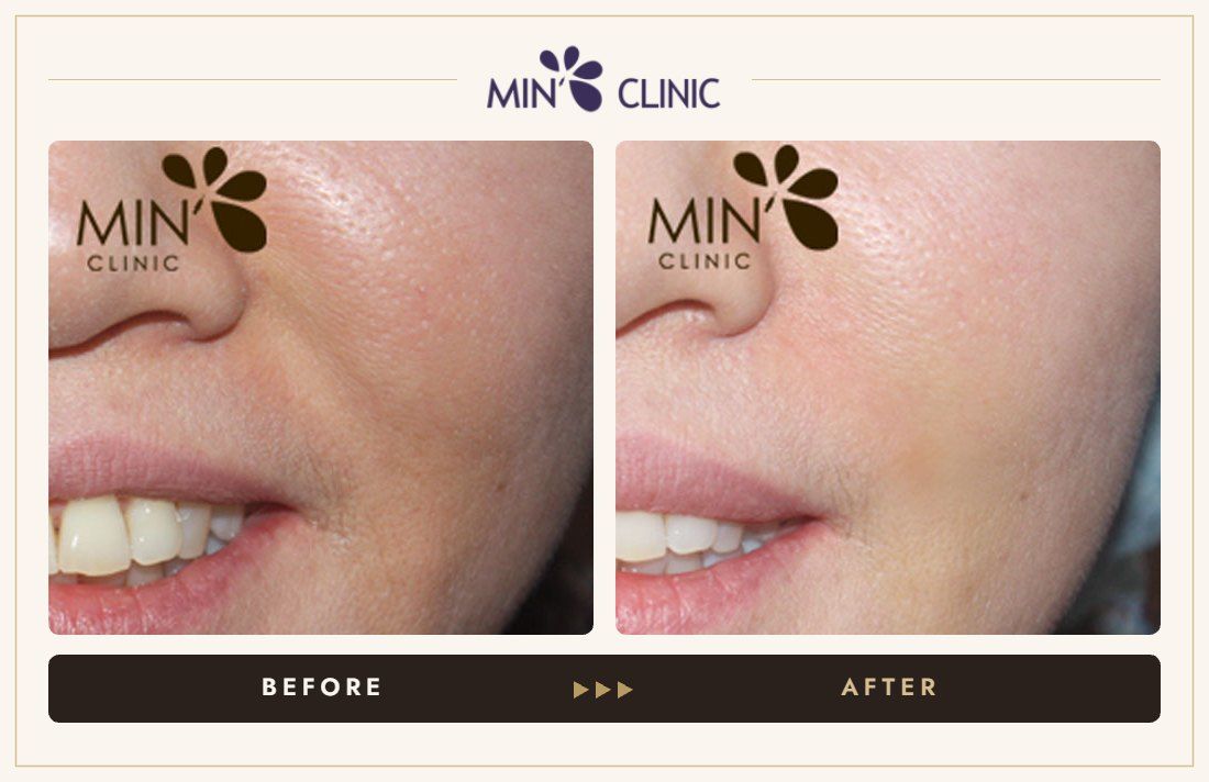 Nasolabial filler before and after, case 15 – MIN Clinic Seoul