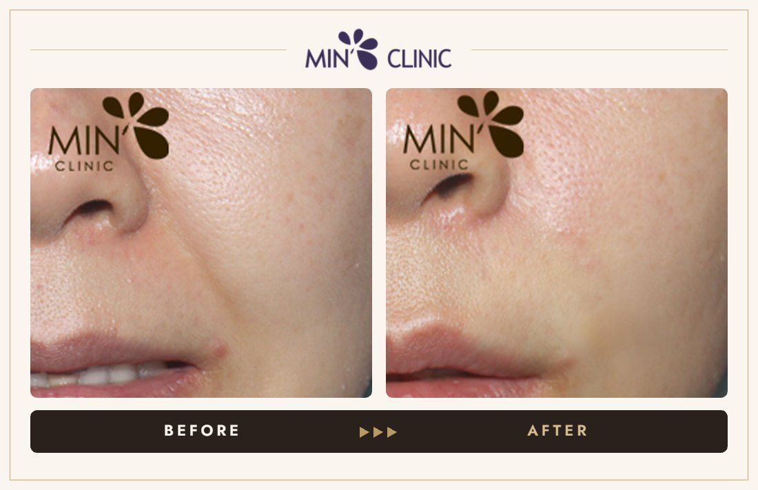 Nasolabial filler before and after, case 17 – MIN Clinic Seoul