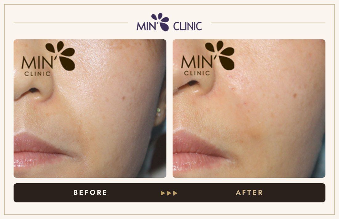 Nasolabial filler before and after, case 18 – MIN Clinic Seoul