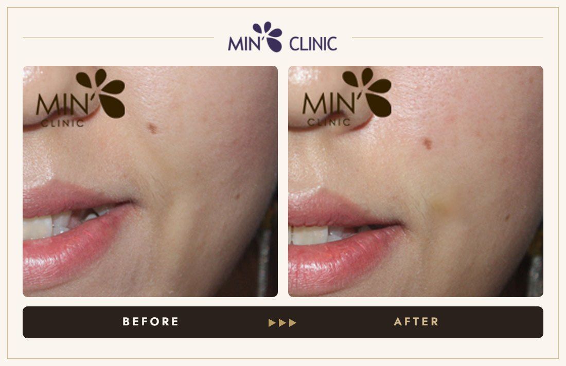 Nasolabial filler before and after, case 20 – MIN Clinic Seoul