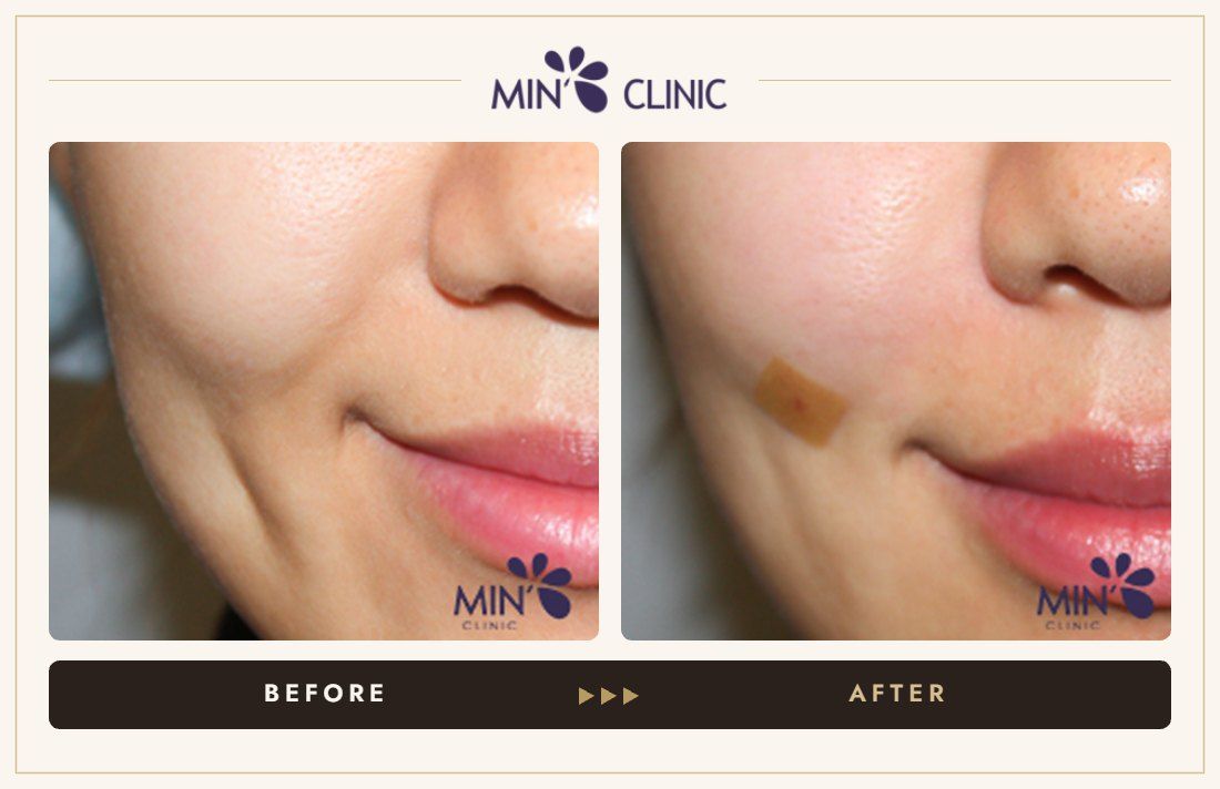 Nasolabial filler before and after, case 21 – MIN Clinic Seoul