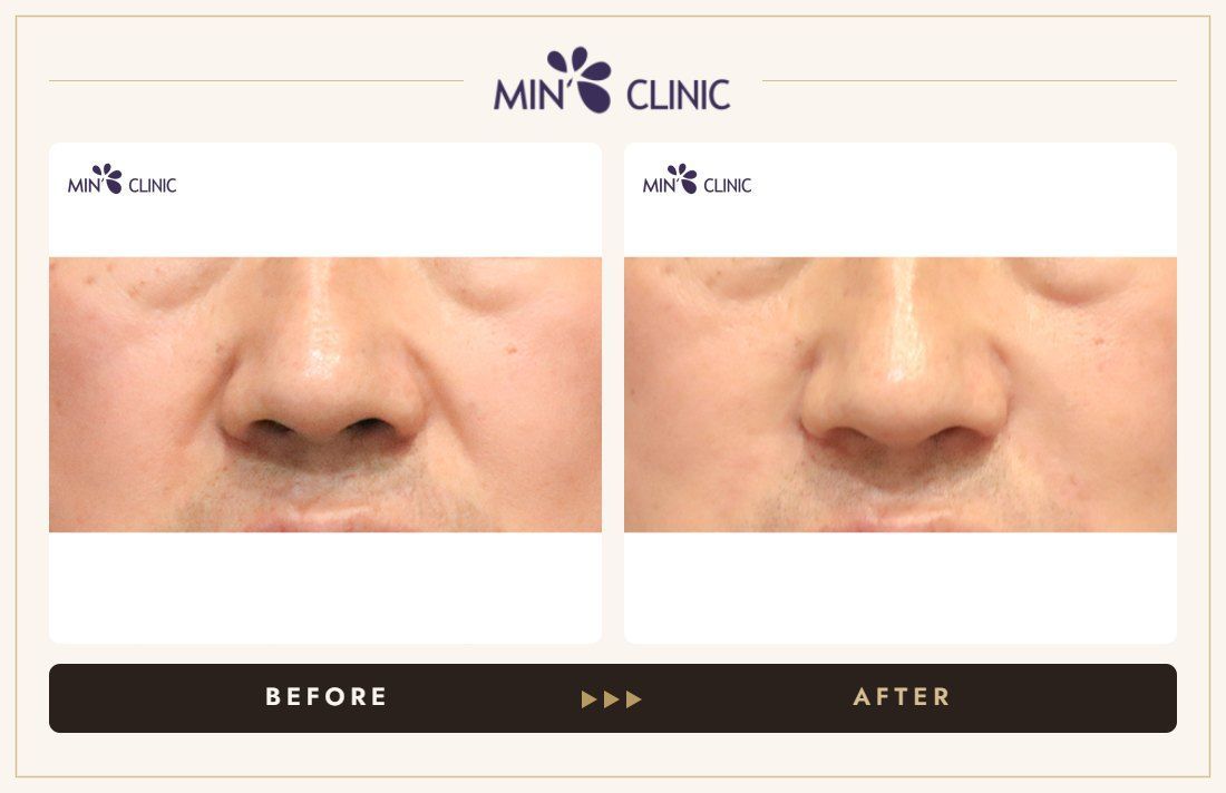 Nasolabial filler before and after, case 22 – MIN Clinic Seoul