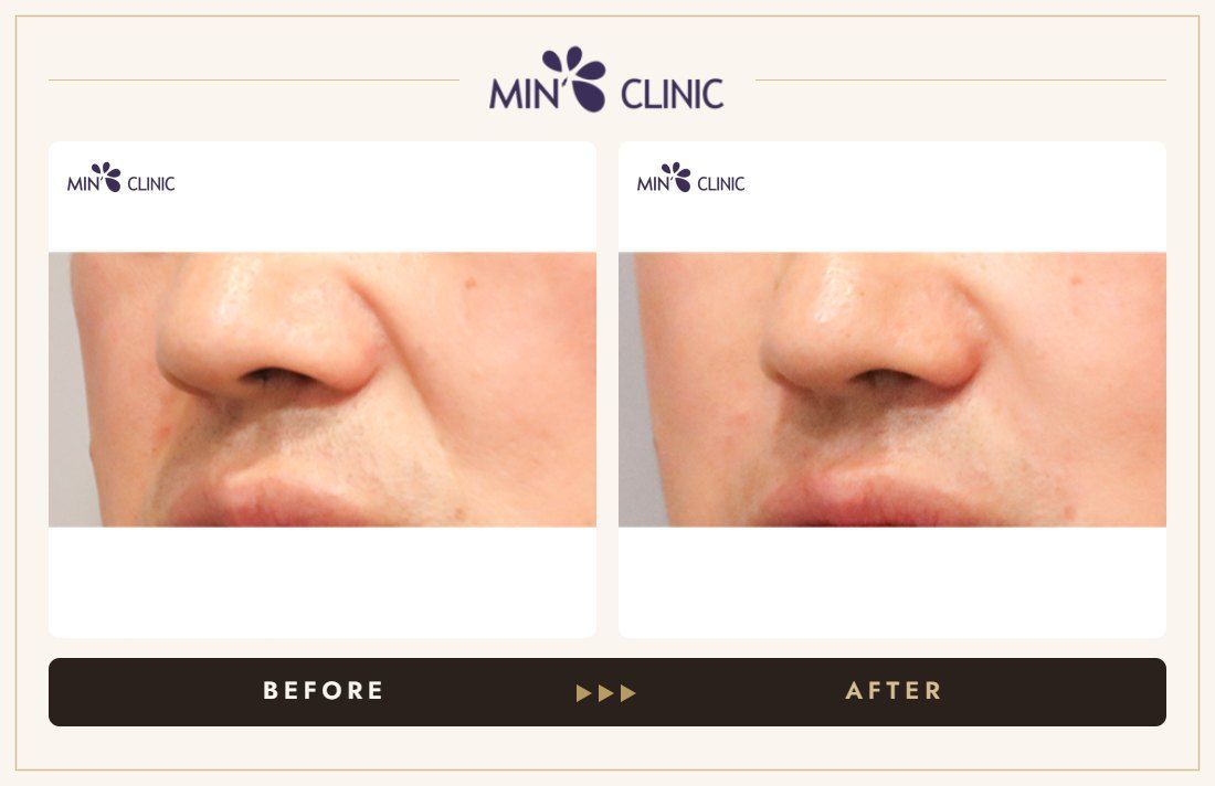 Nasolabial filler before and after, case 23 – MIN Clinic Seoul
