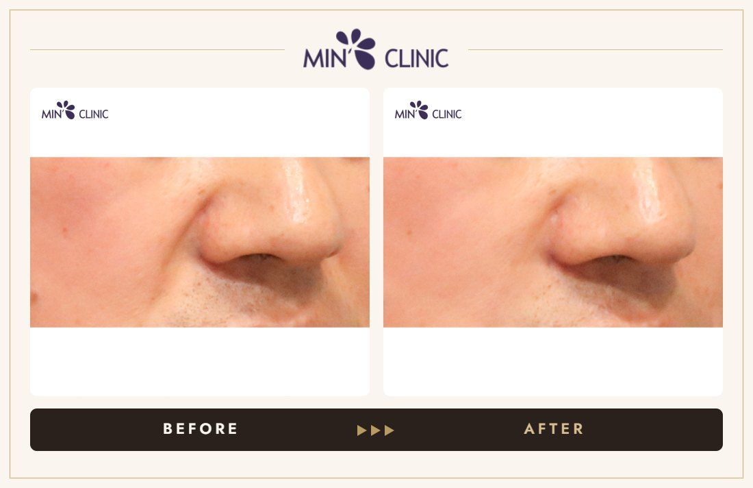 Nasolabial fold filler before and after – MIN Clinic Gangnam, Seoul